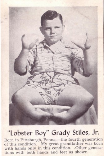 Grady Stiles Jr. Source: http://www.thehumanmarvels.com/blog/wp-content/uploads/GRADY-STILES-The-Lobster-Boy-2-335x500.jpg